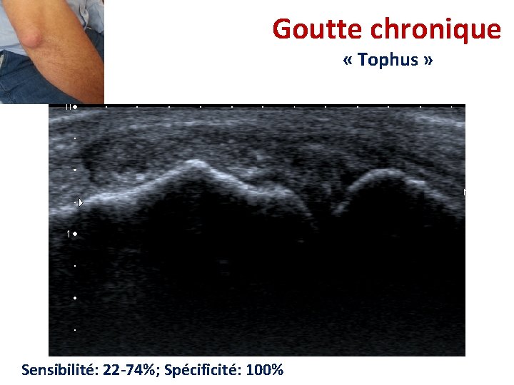 Goutte chronique « Tophus » Sensibilité: 22 -74%; Spécificité: 100% Goutte chronique « Tophus » Sensibilité: 22 -74%; Spécificité: 100%