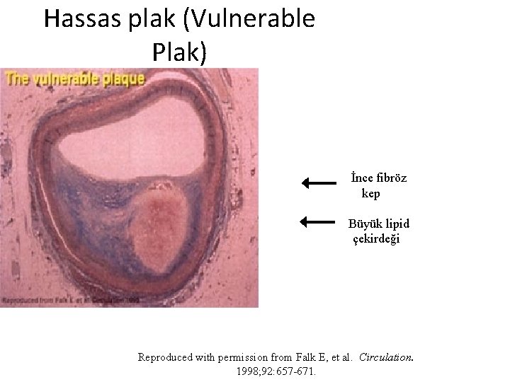 Hassas plak (Vulnerable Plak) İnce fibröz kepinc Büyüklipid Lipid Büyük çekirdeği e, Vulnerable, Fibröz