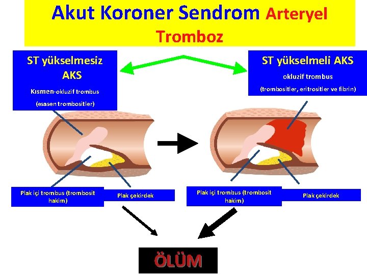 Akut Koroner Sendrom Arteryel Tromboz ST yükselmesiz AKS ST yükselmeli AKS Kısmen-okluzif trombus (trombositler,