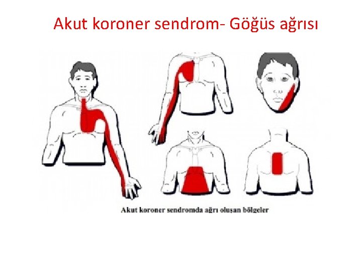 Akut koroner sendrom- Göğüs ağrısı 