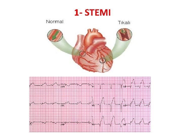 1 - STEMI 