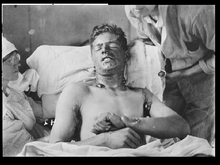 Poison Gas! • Chlorine & Mustard Gas were used • Chlorine Gas – inhaled