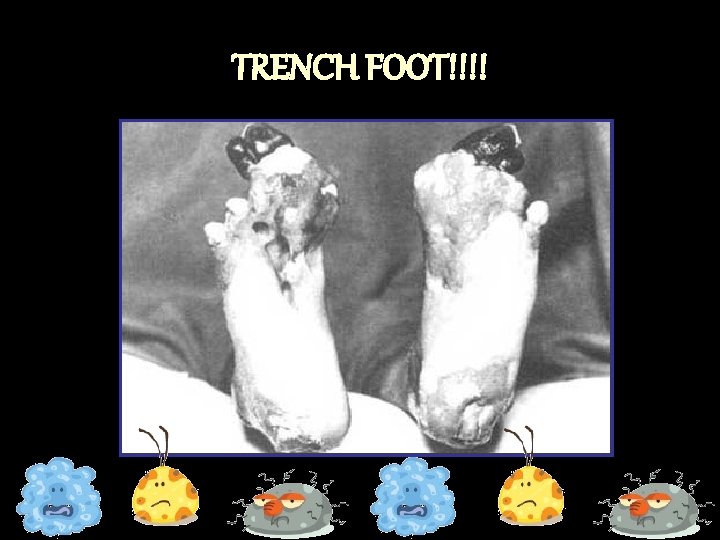 TRENCH FOOT!!!! 