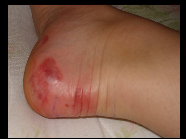 Mrs. Helmer’s “Trench Foot” 