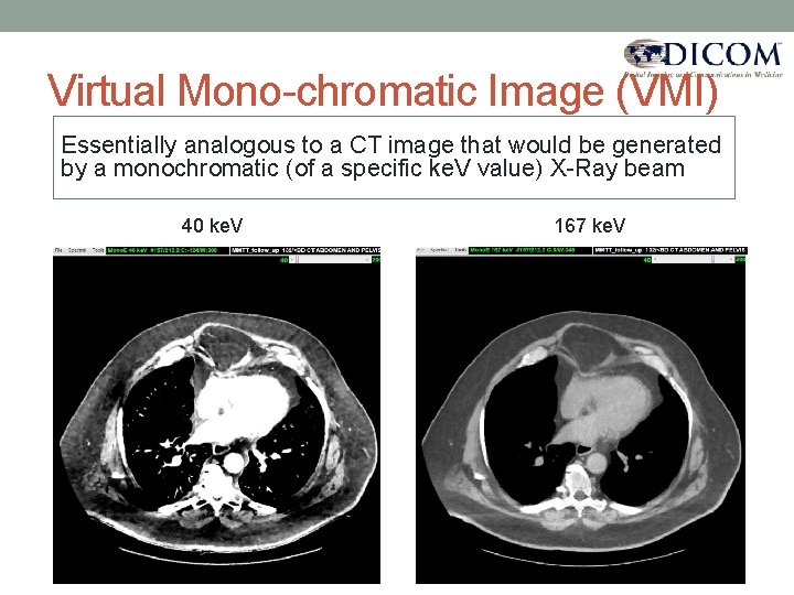 Virtual Mono-chromatic Image (VMI) Essentially analogous to a CT image that would be generated