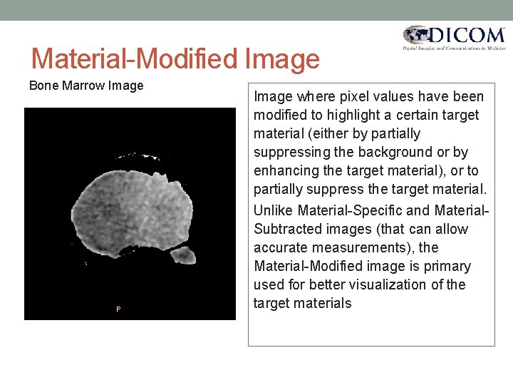 Material-Modified Image Bone Marrow Image where pixel values have been modified to highlight a
