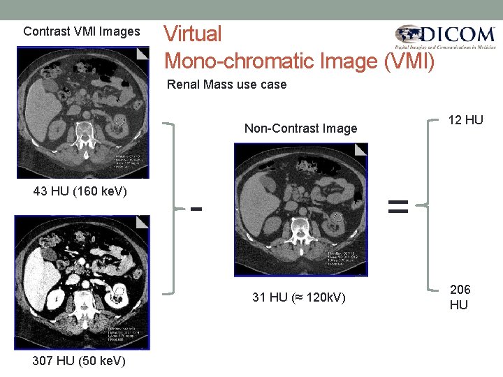 Contrast VMI Images Virtual Mono-chromatic Image (VMI) Renal Mass use case 12 HU Non-Contrast