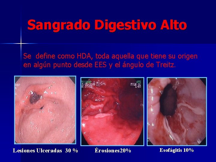 Sangrado Digestivo Alto Se define como HDA, toda aquella que tiene su origen en