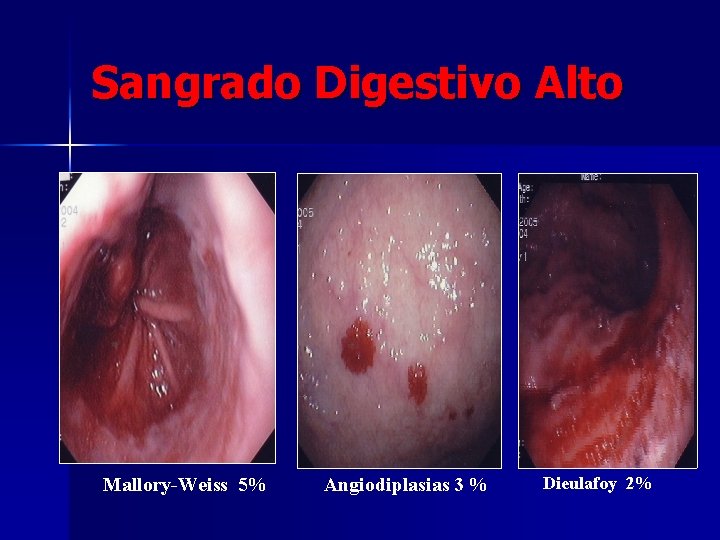 Sangrado Digestivo Alto Mallory-Weiss 5% Angiodiplasias 3 % Dieulafoy 2% 