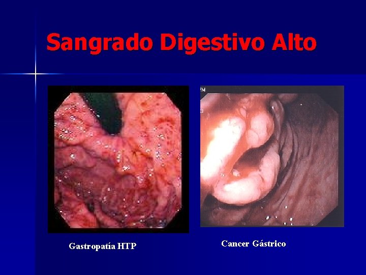 Sangrado Digestivo Alto Gastropatía HTP Cancer Gástrico 