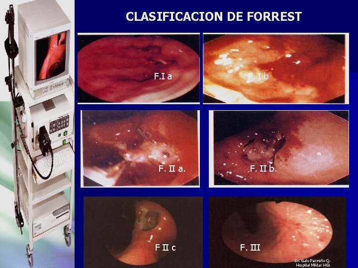 CLASIFICACION DE FORREST F. I a F. I b F. II a. F. II