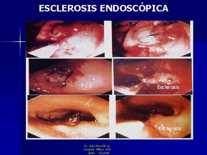 ESCLEROSIS ENDOSCÓPICA F I a F I b FII b Dr. Galo Pazmiño Q.