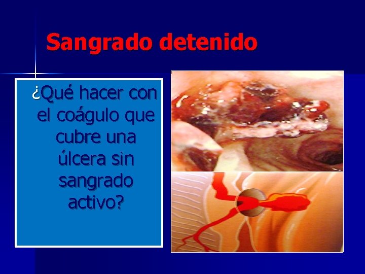 Sangrado detenido ¿Qué hacer con el coágulo que cubre una úlcera sin sangrado activo?