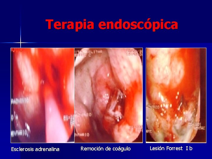 Terapia endoscópica Esclerosis adrenalina Remoción de coágulo Lesión Forrest I b 