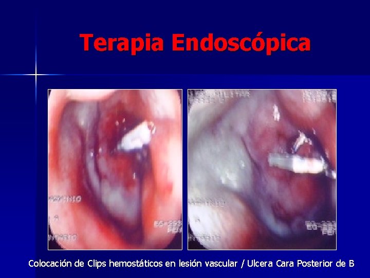 Terapia Endoscópica Colocación de Clips hemostáticos en lesión vascular / Ulcera Cara Posterior de