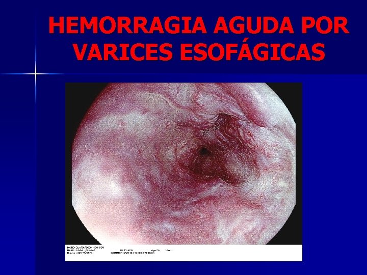 HEMORRAGIA AGUDA POR VARICES ESOFÁGICAS 