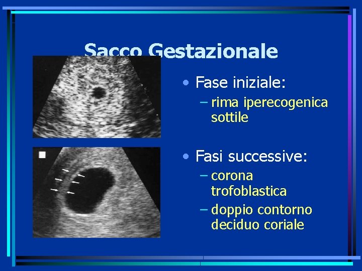 Sacco Gestazionale • Fase iniziale: – rima iperecogenica sottile • Fasi successive: – corona