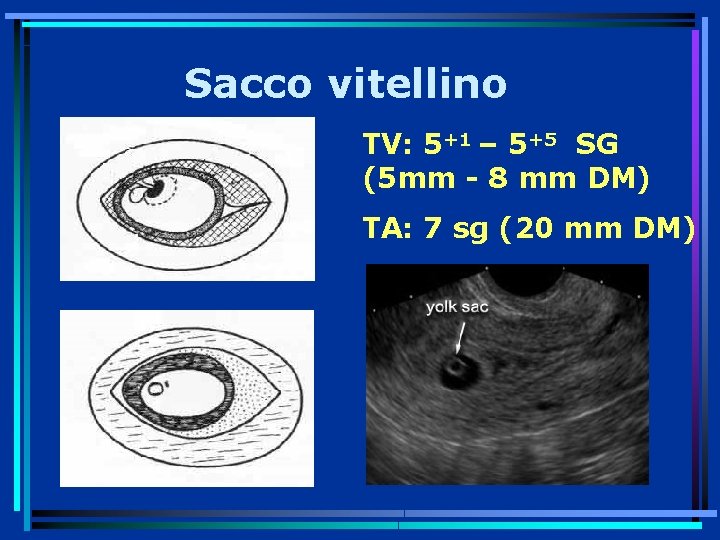 Sacco vitellino TV: 5+1 – 5+5 SG (5 mm - 8 mm DM) TA: