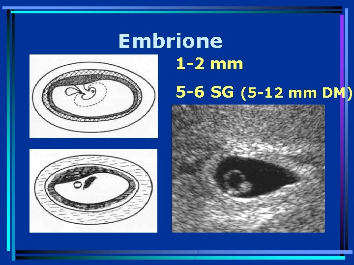 Embrione 1 -2 mm 5 -6 SG (5 -12 mm DM) 