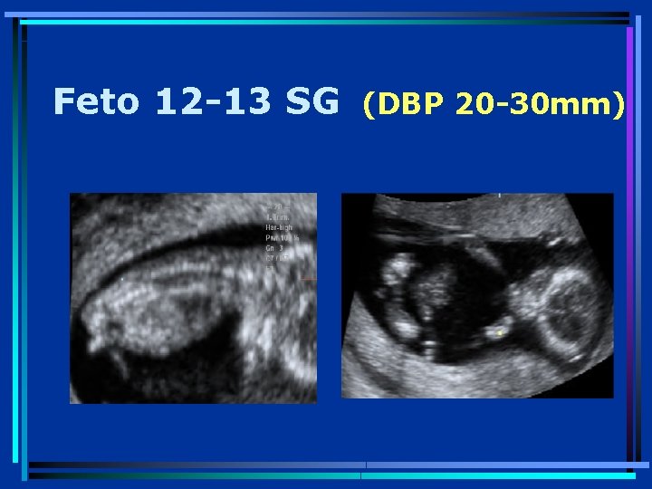 Feto 12 -13 SG (DBP 20 -30 mm) 