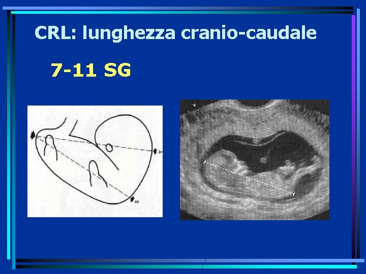 CRL: lunghezza cranio-caudale 7 -11 SG 