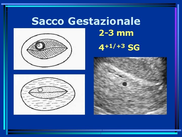 Sacco Gestazionale 2 -3 mm 4+1/+3 SG 