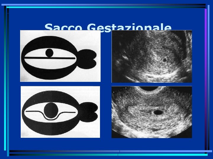 Sacco Gestazionale 