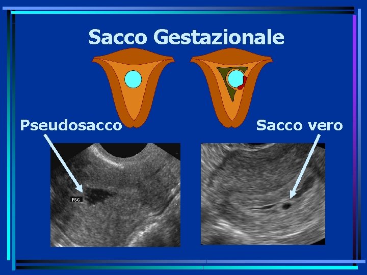 Sacco Gestazionale Pseudosacco Sacco vero 