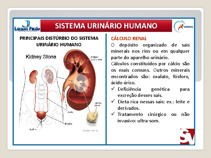 SISTEMA URINÁRIO HUMANO PRINCIPAIS DISTÚRBIO DO SISTEMA URINÁRIO HUMANO CÁLCULO RENAL O depósito organizado