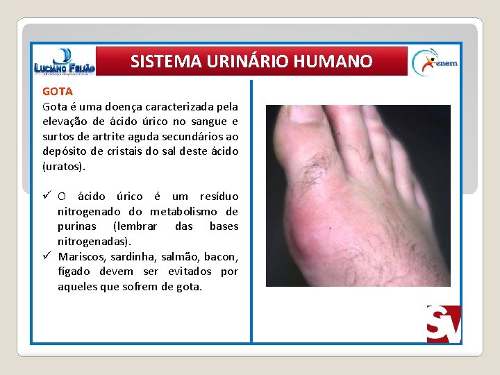 SISTEMA URINÁRIO HUMANO GOTA Gota é uma doença caracterizada pela elevação de ácido úrico