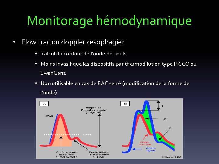 Monitorage hémodynamique • Flow trac ou doppler œsophagien • calcul du contour de l’onde