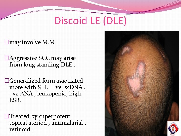 Discoid LE (DLE) �may involve M. M �Aggressive SCC may arise from long standing Discoid LE (DLE) �may involve M. M �Aggressive SCC may arise from long standing