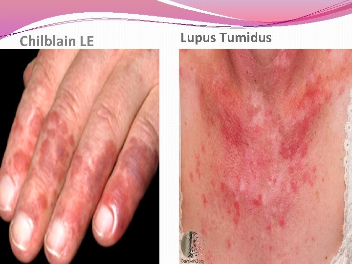 Chilblain LE Lupus Tumidus Chilblain LE Lupus Tumidus