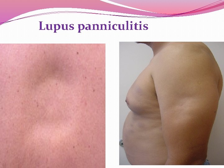 Lupus panniculitis Lupus panniculitis