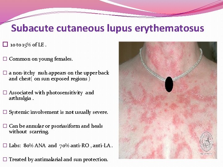 Subacute cutaneous lupus erythematosus � 10 to 15% of LE. � Common on young Subacute cutaneous lupus erythematosus � 10 to 15% of LE. � Common on young