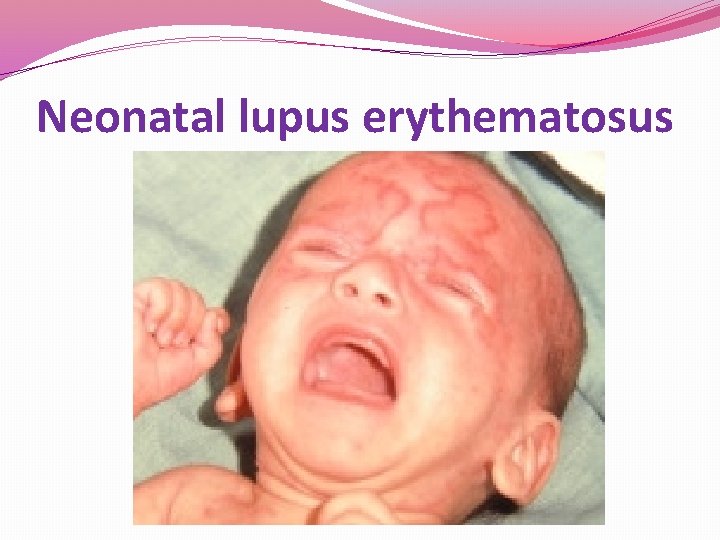 Neonatal lupus erythematosus Neonatal lupus erythematosus