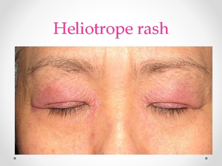 Heliotrope rash Heliotrope rash