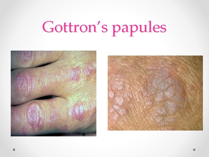Gottron’s papules Gottron’s papules