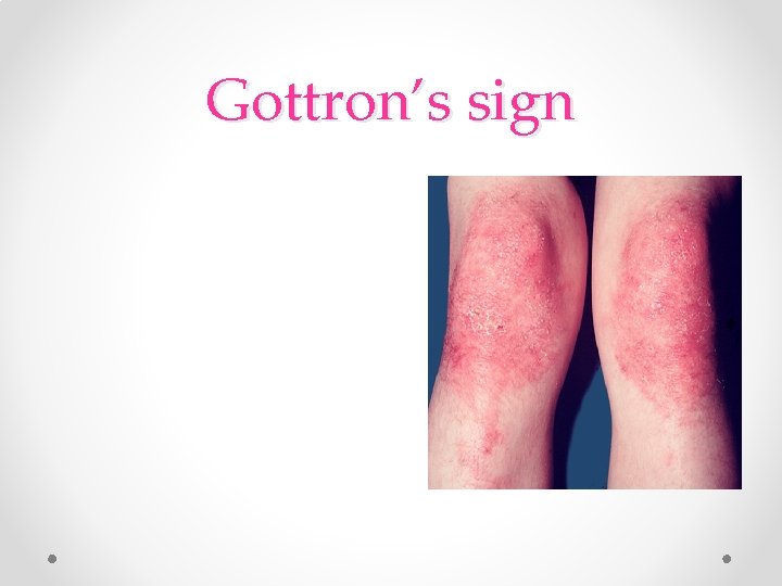 Gottron’s sign Gottron’s sign