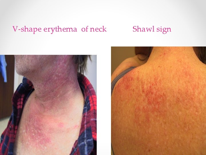 V-shape erythema of neck Shawl sign V-shape erythema of neck Shawl sign