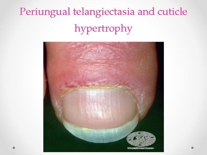 Periungual telangiectasia and cuticle hypertrophy Periungual telangiectasia and cuticle hypertrophy
