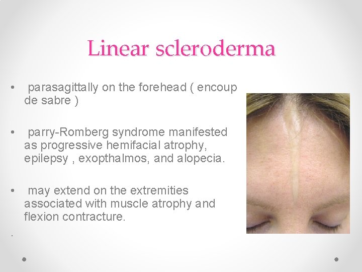 Linear scleroderma • parasagittally on the forehead ( encoup de sabre ) • parry-Romberg Linear scleroderma • parasagittally on the forehead ( encoup de sabre ) • parry-Romberg