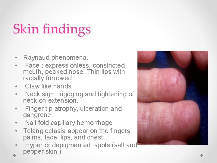 Skin findings • Raynaud phenomena. • Face : expressionless, constricted mouth, peaked nose. Thin Skin findings • Raynaud phenomena. • Face : expressionless, constricted mouth, peaked nose. Thin