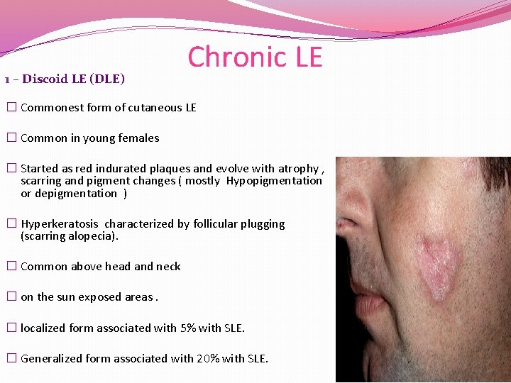 Sle Rash Vs Dle Rash Cutaneous manifestation of SLE and other CTD Diseases