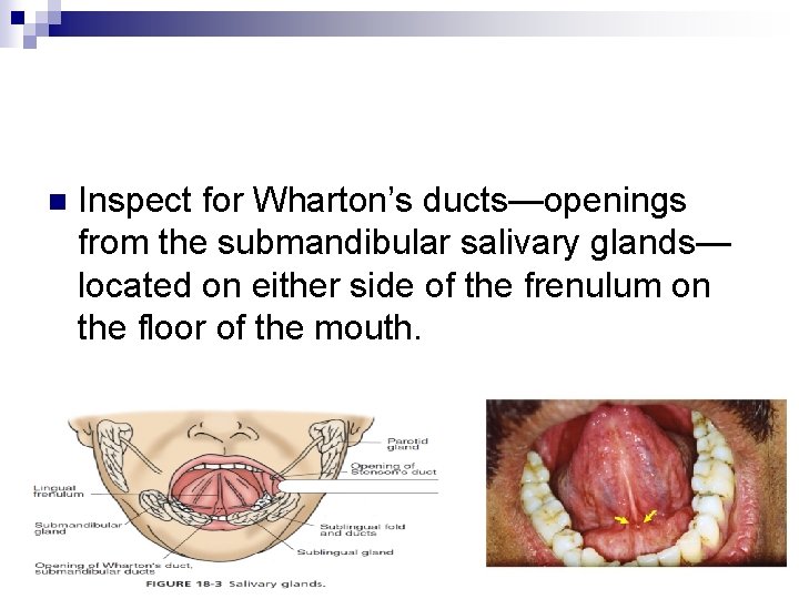 n Inspect for Wharton’s ducts—openings from the submandibular salivary glands— located on either side