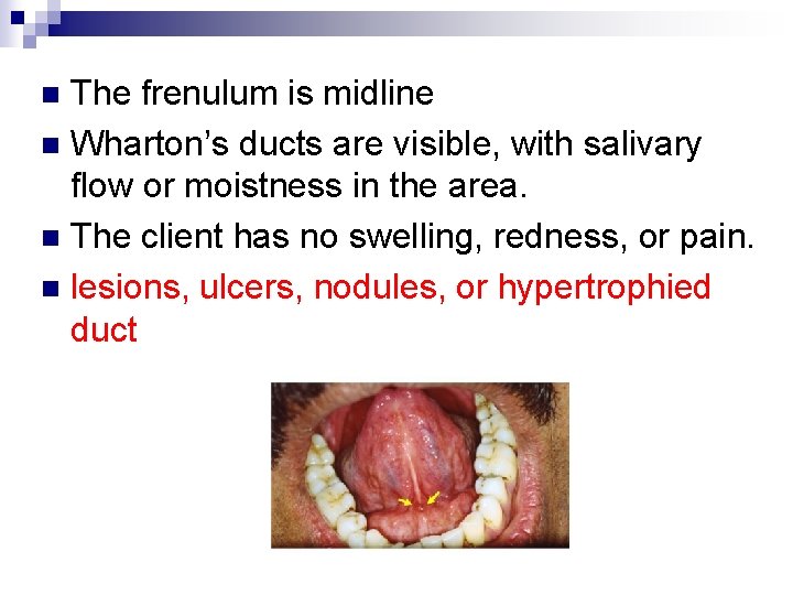 The frenulum is midline n Wharton’s ducts are visible, with salivary flow or moistness