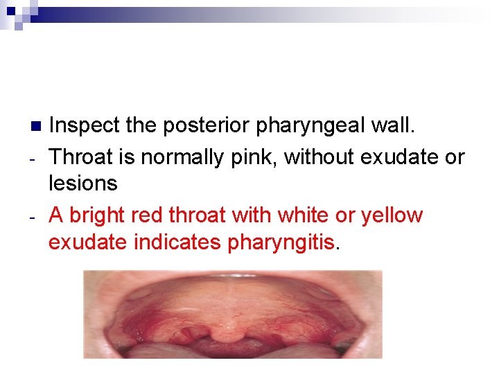 n - Inspect the posterior pharyngeal wall. Throat is normally pink, without exudate or