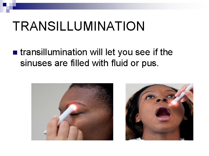TRANSILLUMINATION n transillumination will let you see if the sinuses are filled with fluid