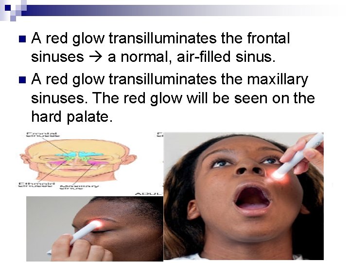 A red glow transilluminates the frontal sinuses a normal, air-filled sinus. n A red