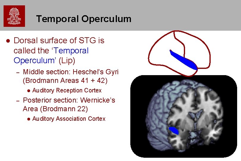 Temporal Operculum l Dorsal surface of STG is called the ‘Temporal Operculum’ (Lip) – Temporal Operculum l Dorsal surface of STG is called the ‘Temporal Operculum’ (Lip) –